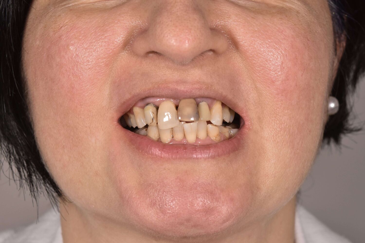 Pacient Clinica Dr. Alin Odor - Rezultat Implantologie
